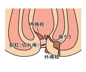 痔の種類