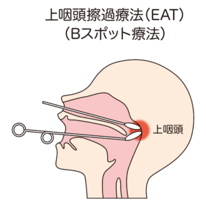 Bスポット治療